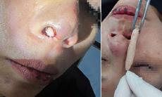 Sau nâng mũi, người phụ nữ phải tháo toàn bộ sụn vì tai nạn