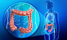 Ai có nguy cơ cao mắc ung thư đại trực tràng?