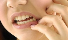 Viêm xương hàm hay bị bỏ qua do triệu chứng dễ nhầm với bệnh răng miệng thông thường