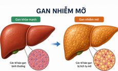 Cách chữa gan nhiễm mỡ độ 1 không dùng thuốc