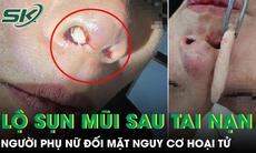 Nâng mũi xong gặp tai nạn, người phụ nữ đối mặt nguy cơ hoại tử mũi