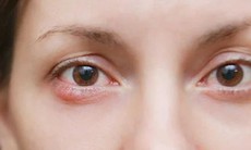 Ngứa rát, khô mắt kéo dài, cảnh giác với viêm bờ mi