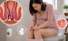 Mẹ bầu làm gì để giảm nguy cơ mắc bệnh trĩ?
