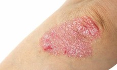 Cách chăm sóc da hàng ngày với người bệnh vảy nến để kiểm soát bệnh hiệu quả