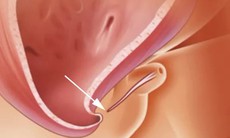Lỗ tiểu thấp ở bé trai, có nên cắt bao quy đầu sớm?