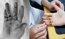 Ngày đầu đi làm, thanh niên 17 tuổi suýt mất 3 ngón tay vì máy cưa