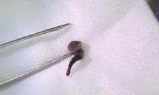 Uống nước ở suối, nam thanh niên bị con đỉa dài 2,5cm chui vào mũi