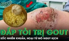 Người đàn ông sốc nhiễm khuẩn, hoại tử mô vì đắp tỏi trị gout