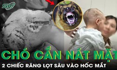 Bé trai 2 tuổi bị chó cắn nát vùng mặt