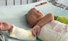 Bé trai dân tộc H’Mông 3 tuổi bị bỏng nặng cần sự giúp đỡ