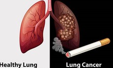 70-80% bệnh nhân ung thư phổi tại Việt Nam được chẩn đoán ở giai đoạn muộn