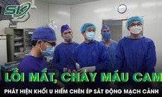 Lồi mắt, chảy máu cam, bé trai 14 tuổi phát hiện khối u hiếm chèn ép sát động mạch cảnh