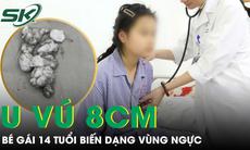 Bé gái 14 tuổi có khối u vú 8cm gây biến dạng