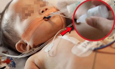 Bé gái 19 tháng tuổi cấp cứu ngưng thở vì ngộ độc thuốc nhỏ mũi