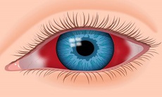 Nhận biết xuất huyết dưới kết mạc
