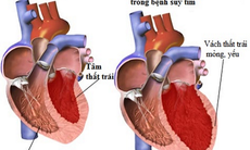 Những biến chứng của nhồi máu cơ tim và cách ngăn ngừa
