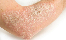 Chia sẻ về căn bệnh “vảy nến” đáng sợ