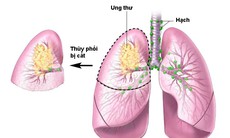 Ung thư phổi có thể nằm ẩn trong cơ thể hơn 20 năm