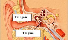 Điều trị viêm tai cấp tính do đi bơi