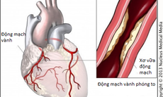 Làm việc nhiều giờ làm tăng nguy cơ mắc bệnh lí mạch vành