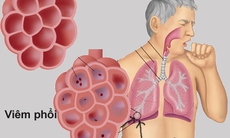 8 dấu hiệu của bệnh viêm phổi bạn không nên bỏ qua
