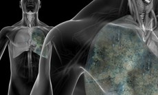 Dấu hiệu nhận biết và cách điều trị bệnh ung thư phổi