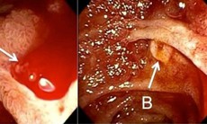 Sau cuộc nhậu, nôn ra cả chậu máu