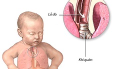 Ðể dị tật tiêu hóa không đe dọa sự sống của trẻ