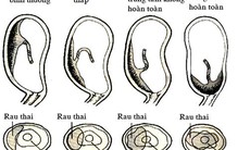 BVĐK huyện Sa Pa, Lào Cai: Cứu sống sản phụ bị mất máu nặng