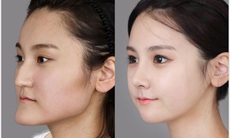 "Ghê răng" trước những cuộc hành xác để làm đẹp