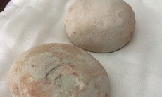 Lấy hai viên sỏi to bằng trứng vịt ra khỏi bàng quang