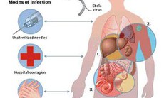 Bệnh Ebola: Hướng dẫn chẩn đoán và điều trị