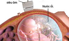 Thiếu nước ối có nguy hiểm?