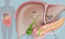 Điều trị viêm tụy cấp do tăng mỡ máu