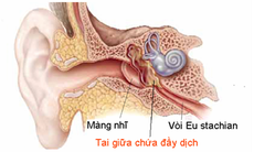 Chớ coi thường viêm tai thanh dịch