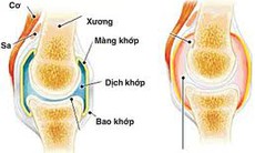 Viêm khớp dạng thấp ở người cao tuổi