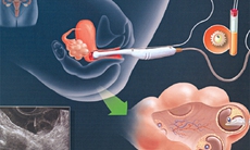 Phác đồ kích thích buồng trứng mới GI giúp phụ nữ vô sinh