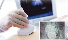 Mang thai đá có gì huyền bí?
