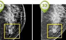 Phát hiện ung thư vú tốt nhất bằng cách chụp tia X-quang 3D