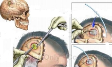 Cách phát hiện áp-xe não