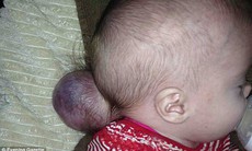 Bé gái có phần não nằm ngoài hộp sọ vẫn sống