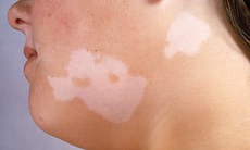 Thuốc điều trị bệnh Vitiligo (bệnh bạch biến)