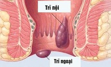 Bệnh trĩ, không nên tự chữa!