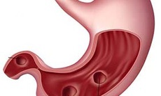 Những vấn đề ở đường tiêu hóa và lưu ý khi dùng thuốc