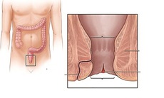Biến chứng của bệnh nứt kẽ hậu môn