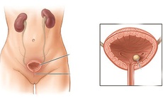 Biến chứng do sỏi bàng quang