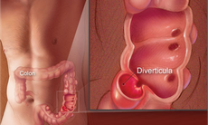 Dùng thuốc nhuận tràng bisacodyl cần lưu ý gì?