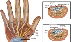 Cải thiện chứng đau đường hầm cổ tay