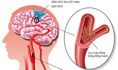 Thiếu máu não – Không nên chủ quan