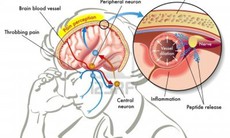 Đau nửa đầu, thuốc nào trị tốt?